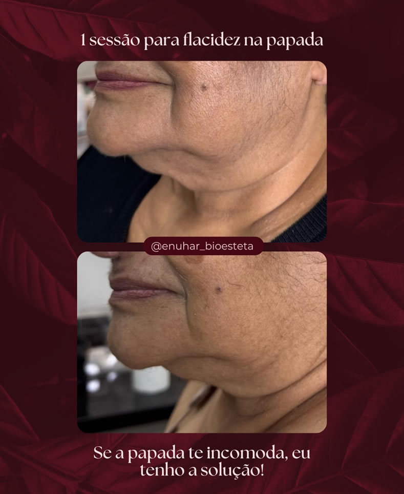 Antes e depois | Protocolo para flacidez na papada - Clínica Enuhar Chartune Águas Claras DF