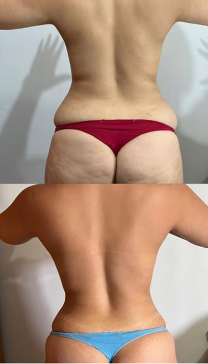 Gordura localizada - Antes e depois - Clínica Enuhar Chartune Águas Claras DF