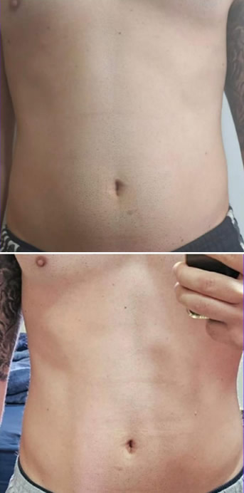 Gordura localizada - Antes e depois - Clínica Enuhar Chartune Águas Claras DF