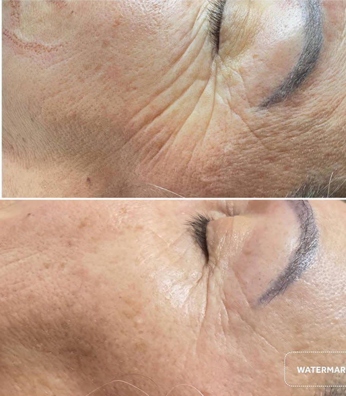 Jato de plasma - Antes e depois - Clínica Enuhar Chartune Águas Claras DF