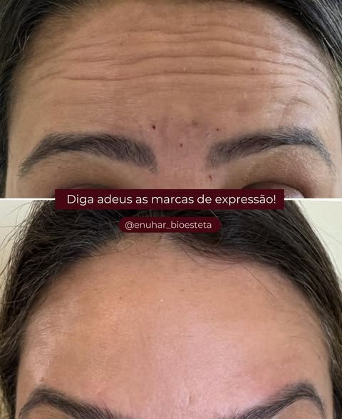 Botox Facial - Antes e depois | Marcas de Expressão - Clínica Enuhar Chartune Águas Claras DF