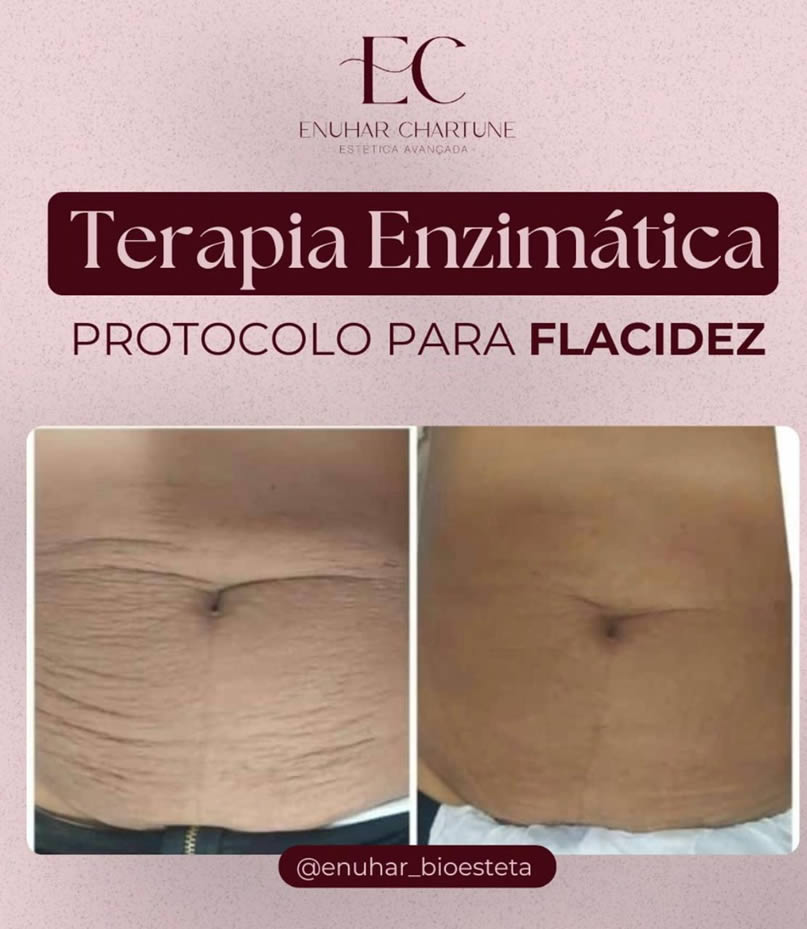 Terapia enzimática - Antes e depois - Clínica Enuhar Chartune Águas Claras DF