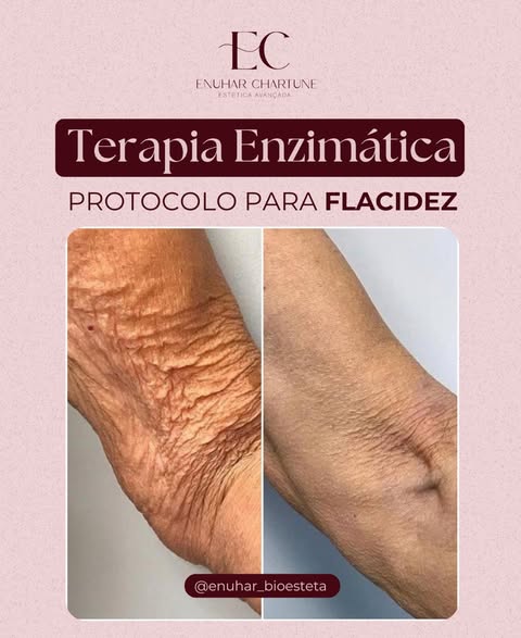 Antes e depois | Protocolo para flacidez - Clínica Enuhar Chartune Águas Claras DF