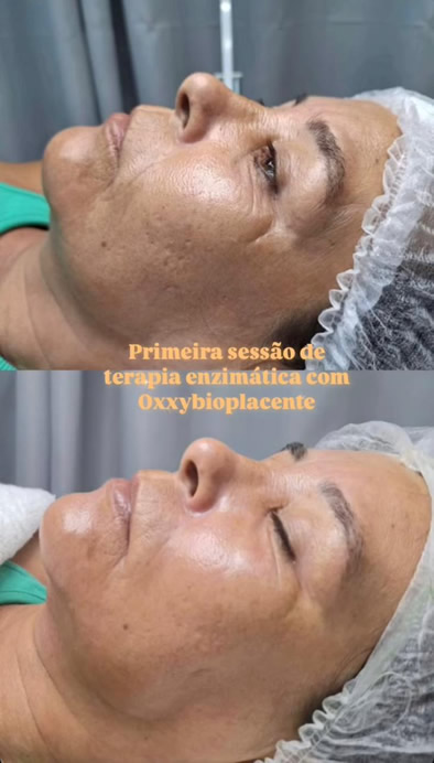 Terapia enzimática - Antes e depois - Clínica Enuhar Chartune Águas Claras DF