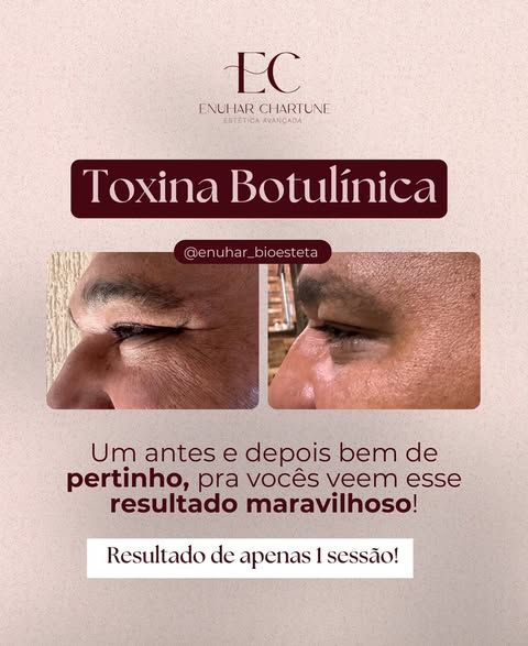 Antes e depois | Toxina botulínica - Clínica Enuhar Chartune Águas Claras DF